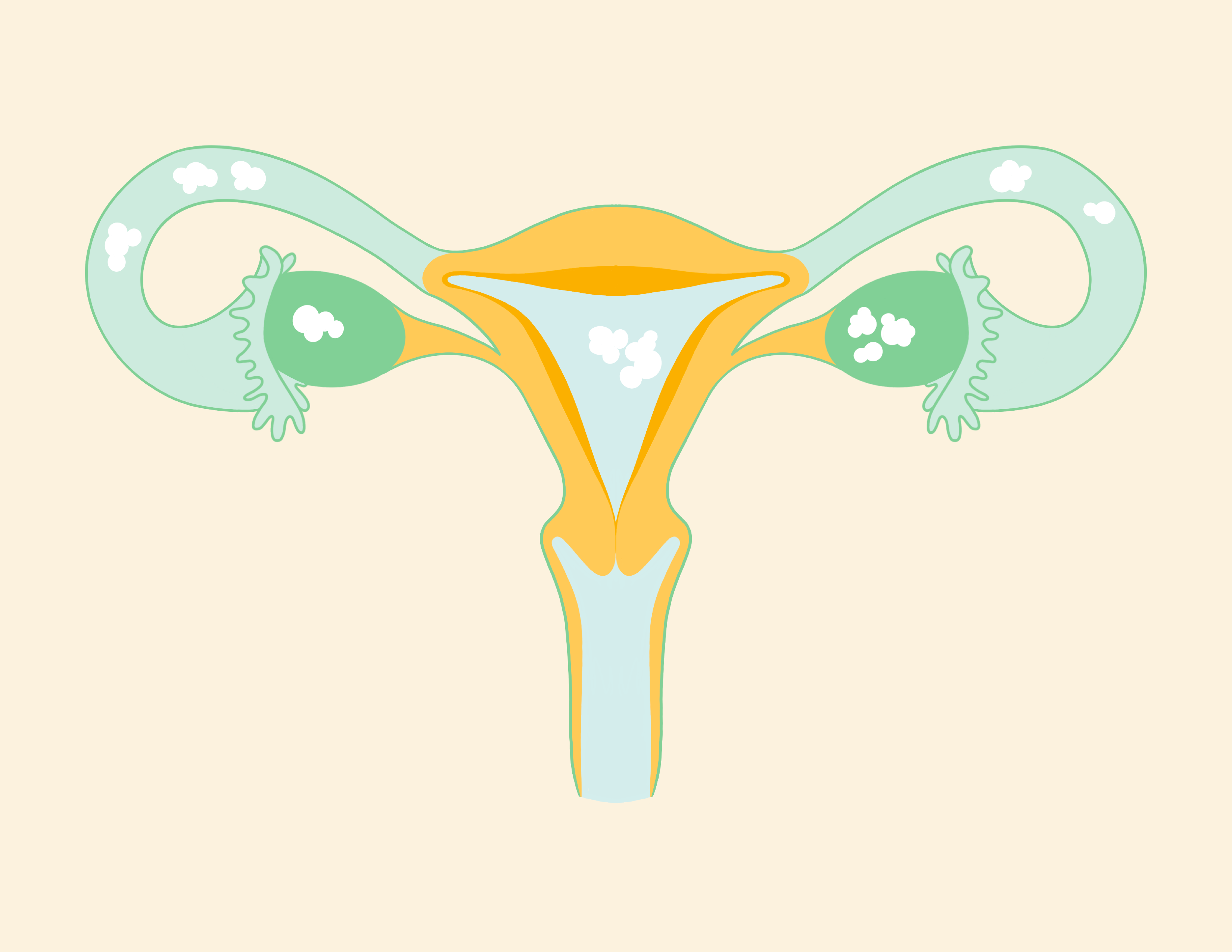 Ovarian Cancer Stage 2