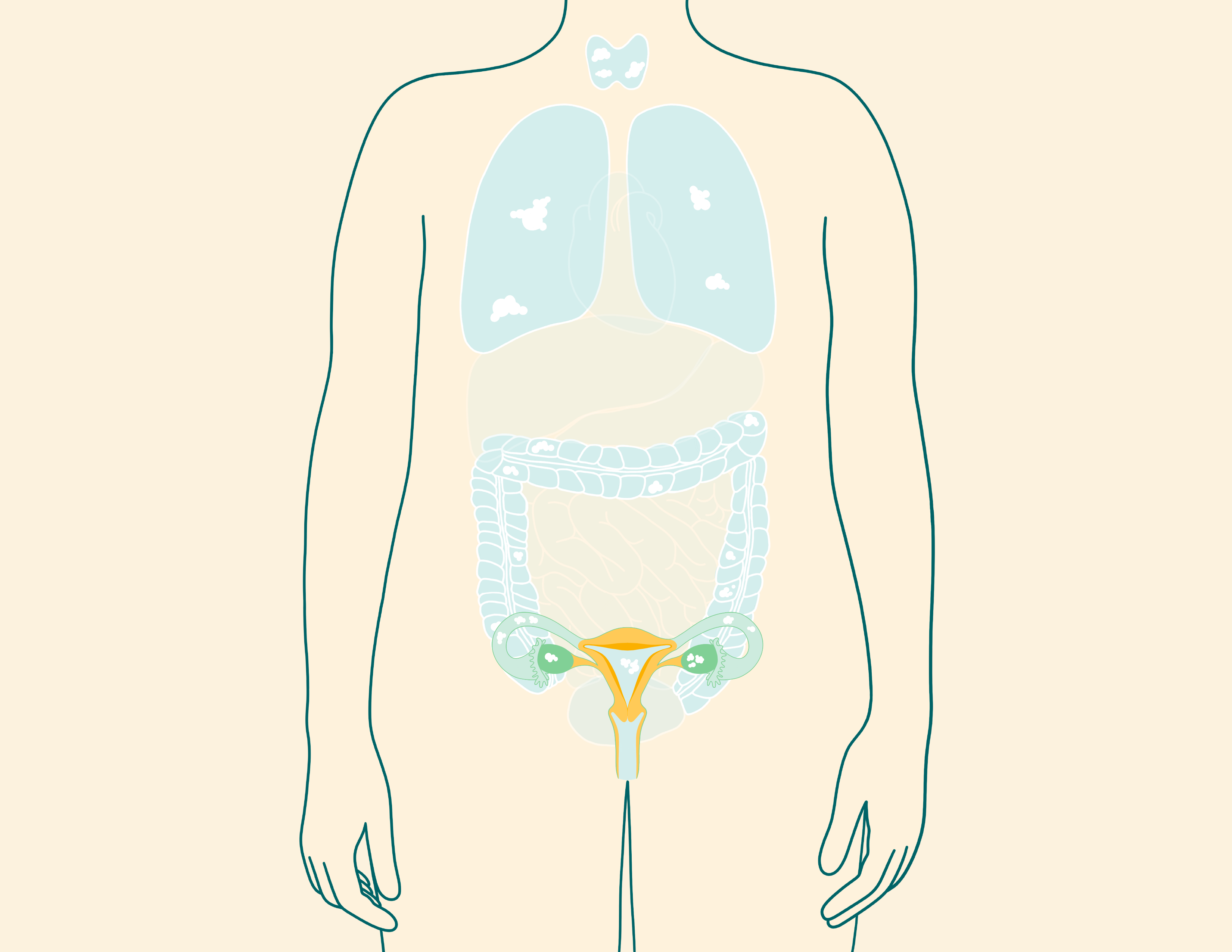 Ovarian cancer stage 4